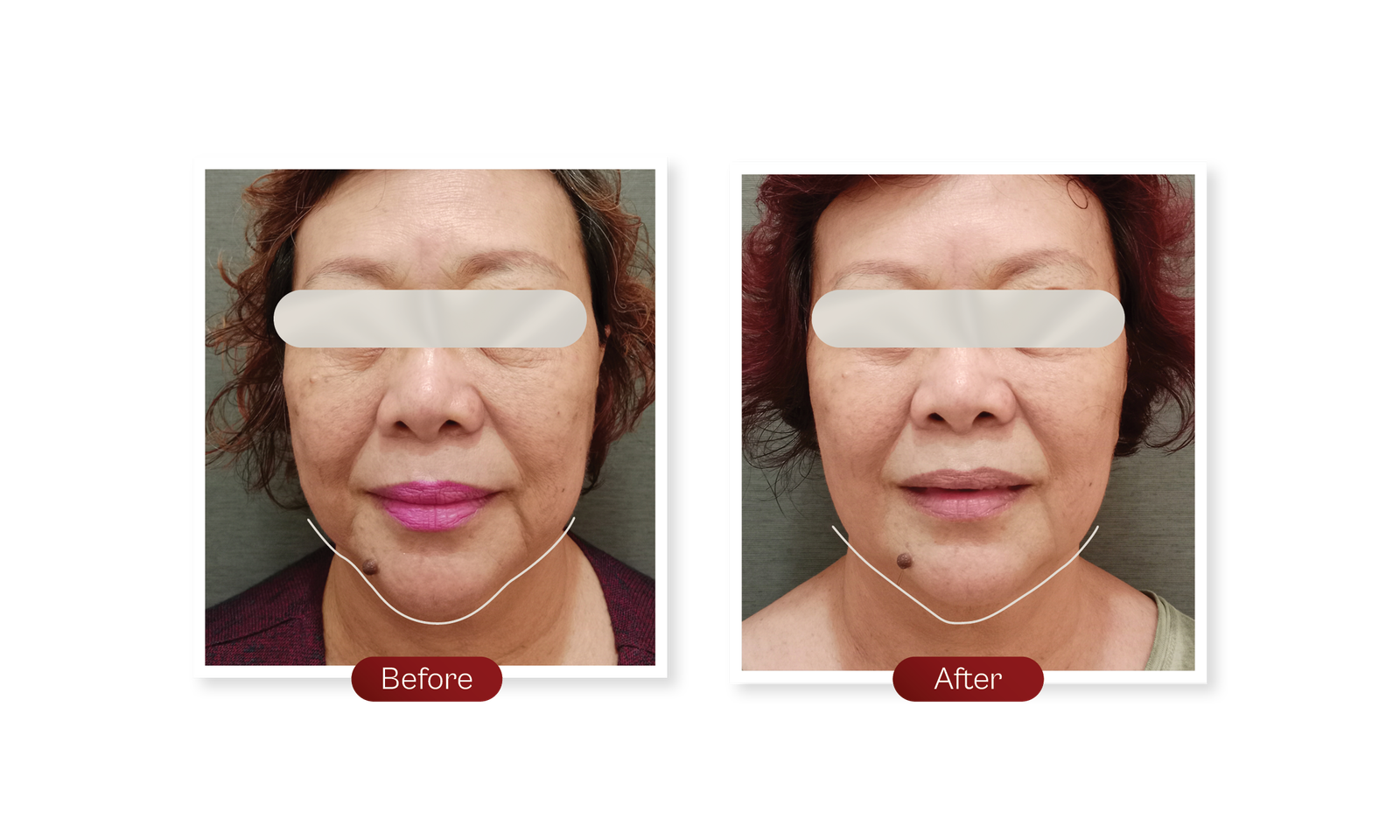 Website-Sequoia-Before after Endolift