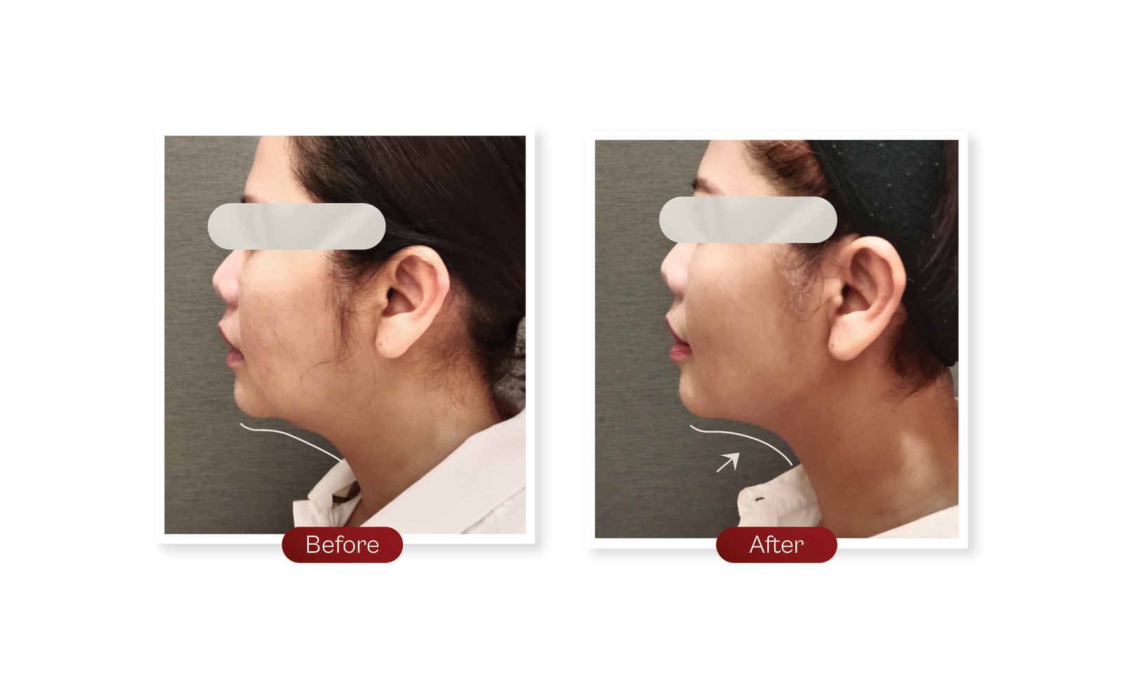 Website-Sequoia-Before after Endolift2