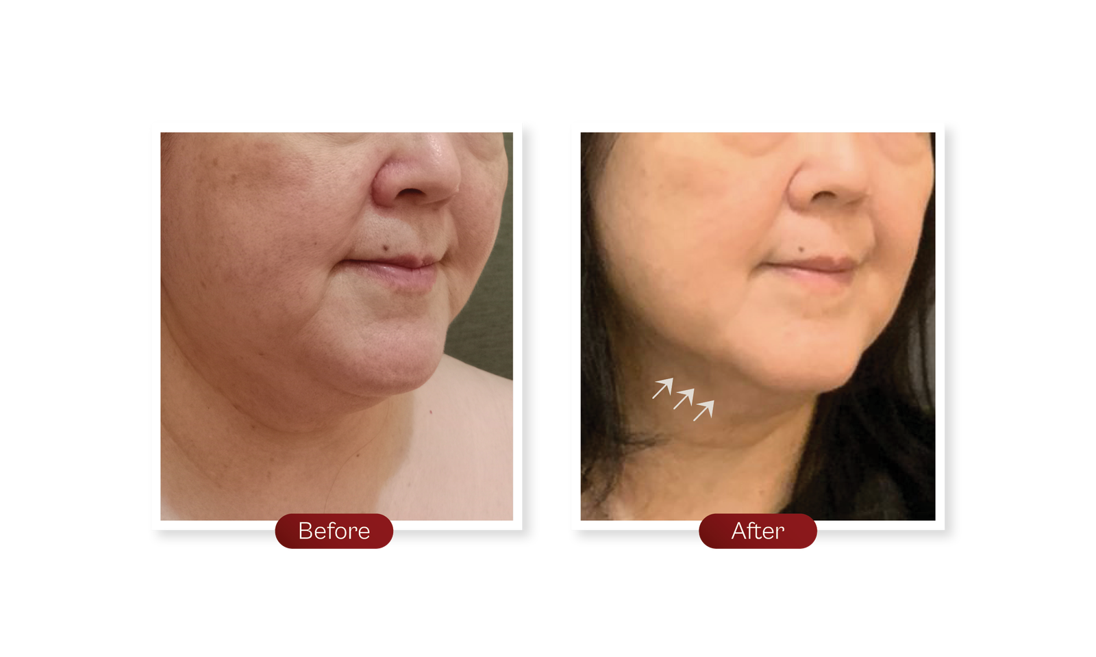 Website-Sequoia-Before after Endolift3